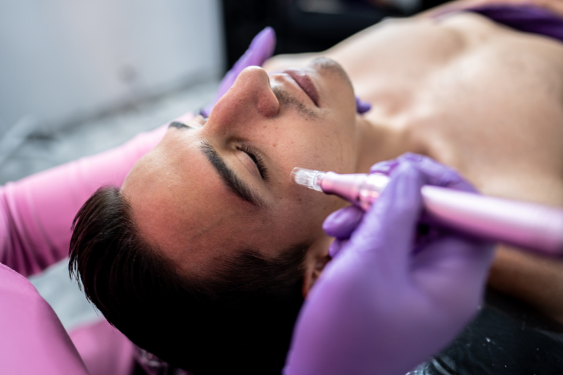 Microneedling San Antonio: The Key to Youthful and Radiant Skin