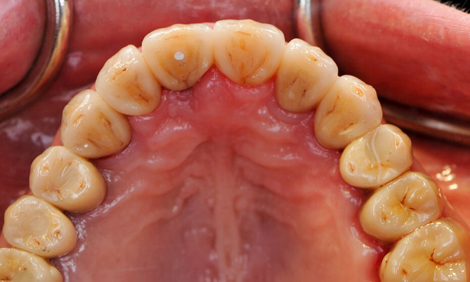 Is Full Mouth Reconstruction Worth the Cost? A Complete Patient Guide