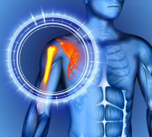 Revision-Corrective-Shoulder-Surgery