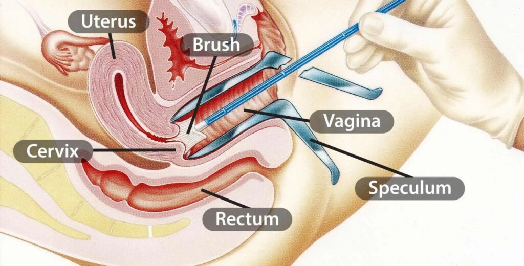 What Is a Pap Smear?