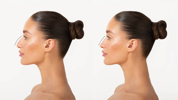 What Should You Avoid After Rhinoplasty in Riyadh Surgery?